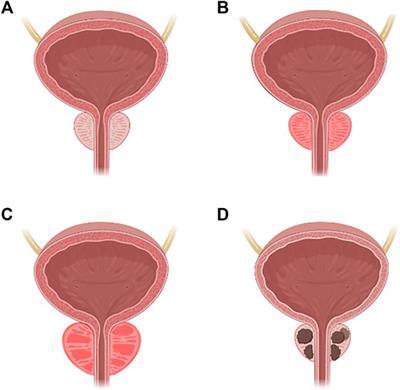 The Impact of Metabolic Syndrome and Type 2 Diabetes Mellitus on Prostate Cancer